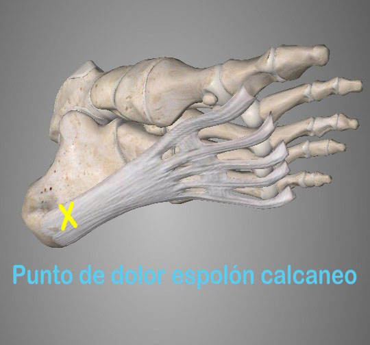 El espolón calcáneo, esta lesión consiste en una calcificación en el tubérculo posteriorinterno del hueso calcáneo del pie