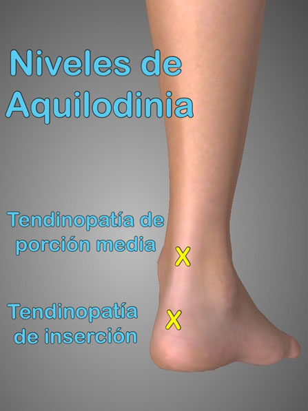 La tendinopatía de Aquiles, lesión de la parte posterio del talón, puede ser tratada con ondas de choque en Donostia