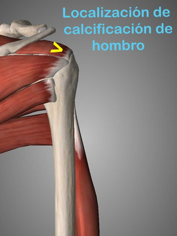 La tenidonpatía de hombro es una lesión aparece por movimientos repetitivos y sobreesfuerzos del hombro que provocan una inflamación y calcificación del tendón