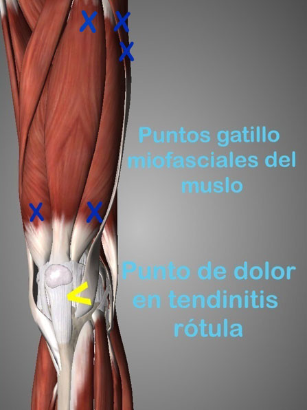 La tendinopatía de rótula es una lesión consiste en una inflamación por sobreuso del tendón rotuliano localizado en la parte inferior de la rótula uniendola con la tibia