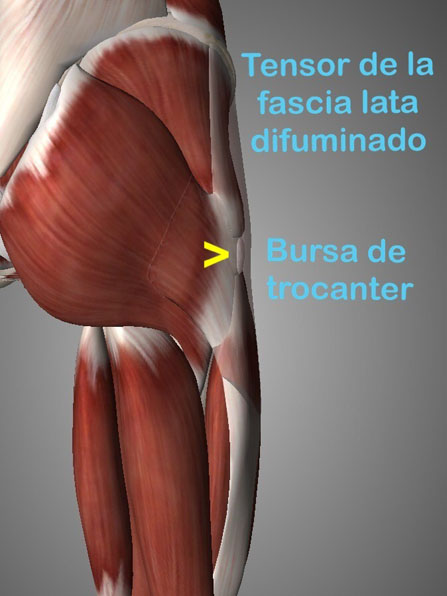 La trocanteritis o bursitis trocantérea, esta lesión se caracteriza por dolor en la cara lateral de la cadera y en ocasiones llega hasta la rodilla causando imptencia funcional