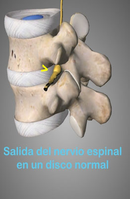 Las hernias discales son abombamientos o herniación de la parte blanda del disco hacia la zona exterior o anillo fibroso, esa deformidad puede irritar la raíz nerviosa adyacente