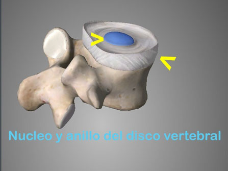  La lumbociática consiste en una irritación del nervio ciático y es una de las afecciones más dolorosas e incapacitantes que suelen sufrir los pacientes con dolor lumbar o lumbalgia