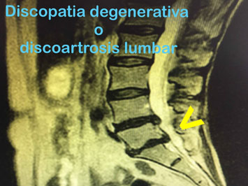  La lumbociática consiste en una irritación del nervio ciático y es una de las afecciones más dolorosas e incapacitantes que suelen sufrir los pacientes con dolor lumbar o lumbalgia